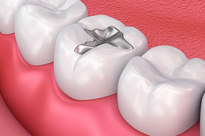 Dentistry for Life | Veneers, Root Canals and Air Abrasion