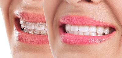 Dentistry for Life | Dental Bridges, All-on-4 reg  and Root Canals