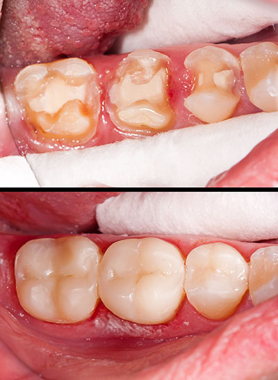 Dentistry for Life | All-on-4 reg , Implant Dentistry and Periodontal Treatment