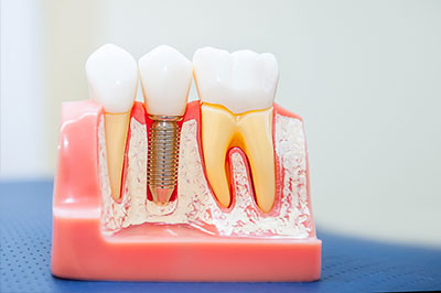 Dentistry for Life | Dental Fillings, Extractions and Veneers