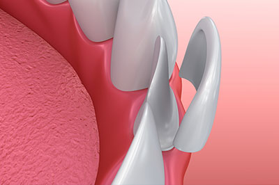Dentistry for Life | TMJ Disorders, Dental Cleanings and Crowns