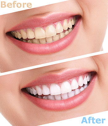Dentistry for Life | Preventative Program, Oral Exams and Oral Cancer Screening