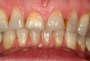 Dentistry for Life | Dental Bridges, All-on-6 reg  and Crowns