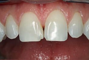 Dentistry for Life | Air Abrasion, Veneers and Oral Cancer Screening